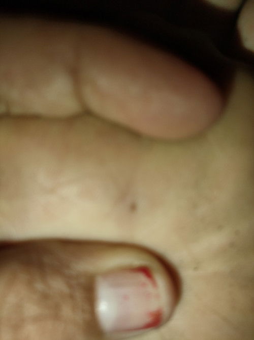 Suntik TT ibu hamil dan suntik TT pada kaki yang terkena paku berkarat sama atau tidak ?