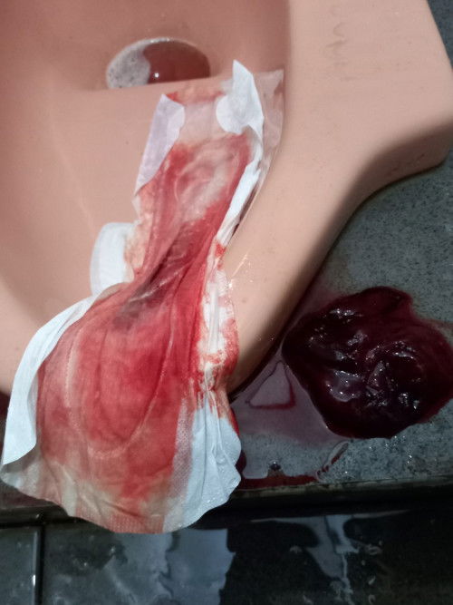 2minggu pasca lahiran keluar darah dengan gumpalan besar