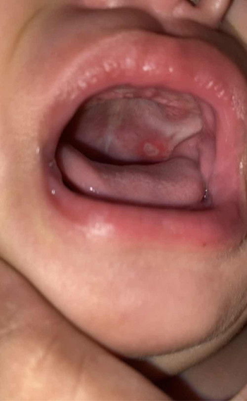 May singaw si baby ko 6 months old