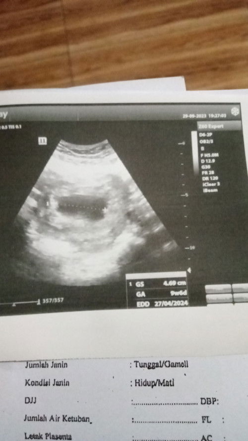 Kuretase kedua kalinya