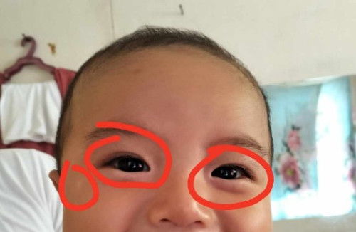 Puti sa paligid ng mata ni baby