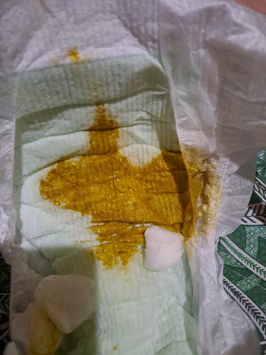 Baby poop, normal or not?