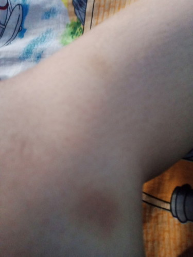 Bunda ada yang sama gak sie badan semenjak hamil banyak yang biru2 sendiri itu kenapa ya