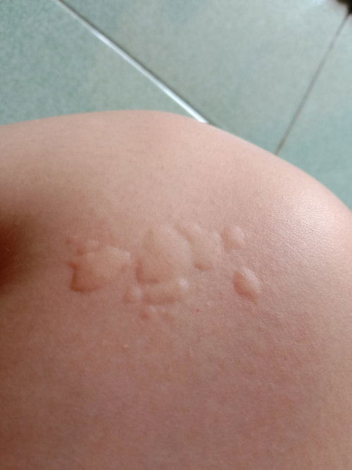 Gatal seperti kena ulat bulu