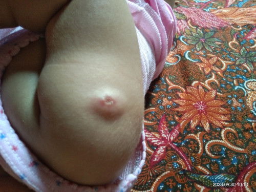 Ini bekas imunisasi berapa lama ya sembuhnya?