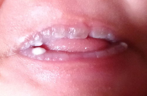 bibir anak ada bintik