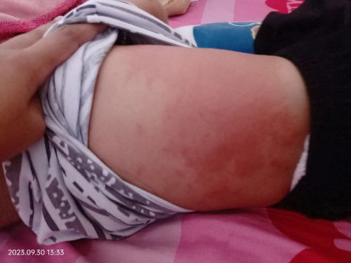 Bund mau tanya obat untuk kemerahan pada punggung bayi apa yah?