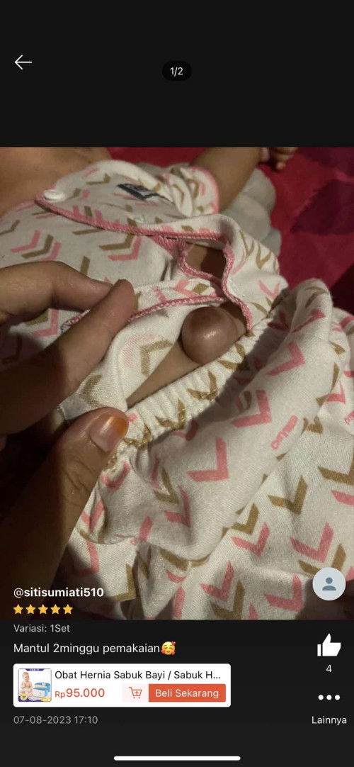 Hernia pada bayi 2 bulan