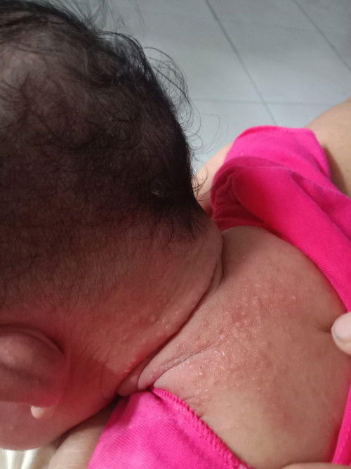 Bun ini apa ya? Dan bagaimana cara pengobatanya