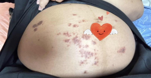 คันแล้วเกา เลยเป็นแผล