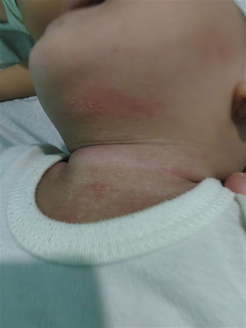 Baby Neck Rash