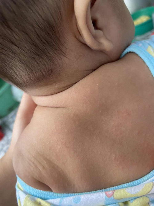 ตุ่มเม็ดเล็กๆขึ้นที่หลัง