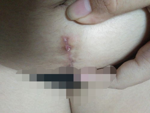 คืออะไรค่ะพอดีผ่าถุงน้ำในรังไข่มาประมสณ1เดือนแล้ว