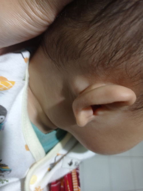 Benjolan di belakang telinga