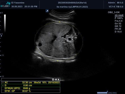 Bun ada yg sama gak? 
Hamil ke minggu 38wkair ketuban sblh kanan hitam sebelah kiri tinggal sedikit?