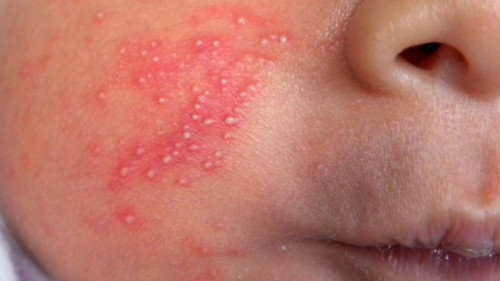 Bị vậy là bị gì các mom bé nhà em bị hai bên cổ vai nhiều lắm ạ