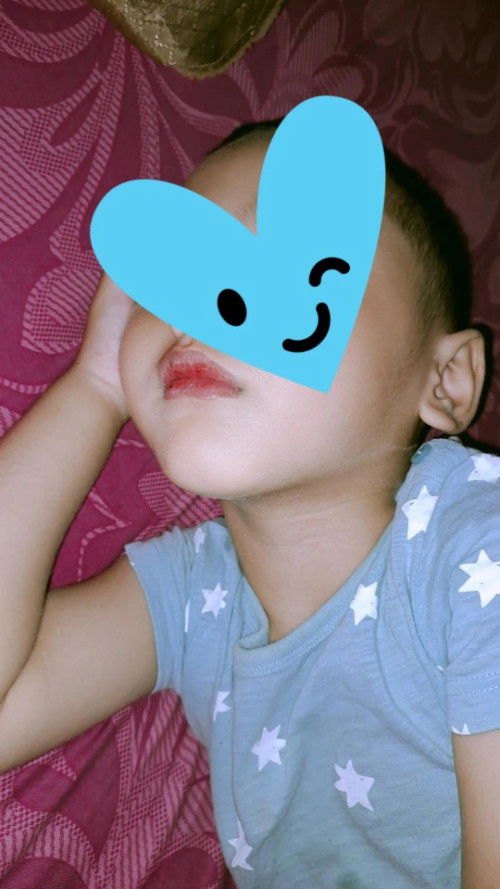 Bibir anak kering