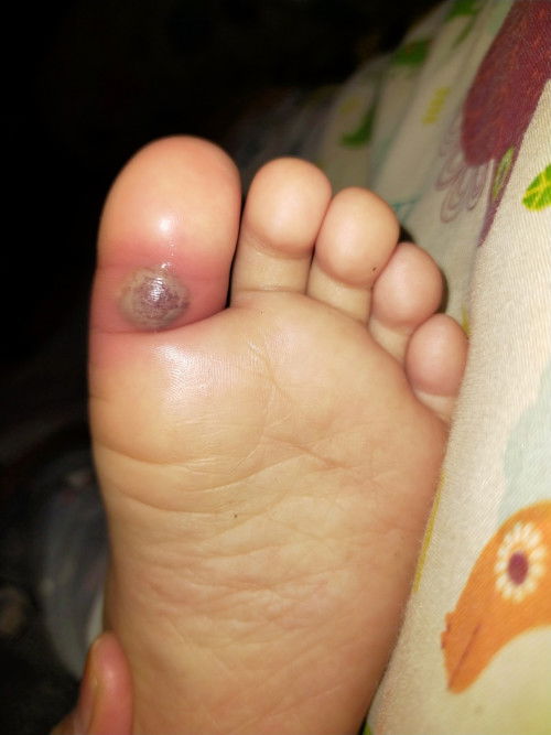 Mata ikan pada anak 22 bulan