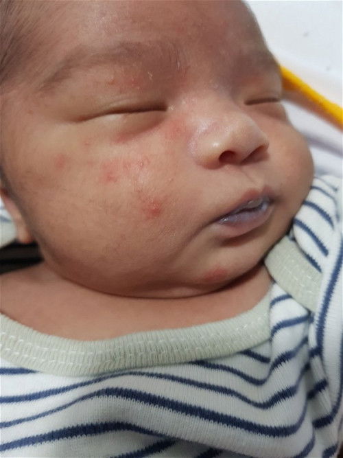 Ano po magandang pampawala ng pula pula sa mukha ng baby ko po thank you