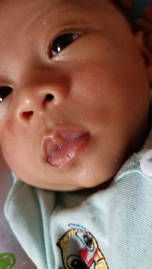 Ada yang tahu cream ruam bintik putih kemerahan gini bun??