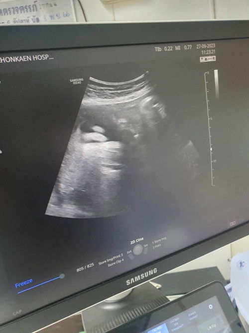 ดูเพศน้องยังไงค่ะ