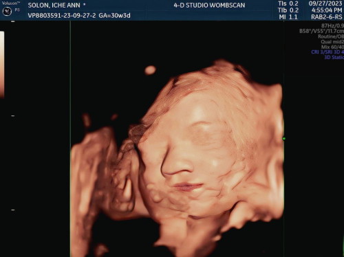 4-D ULTRASOUND
