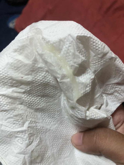 มีมูกไหลออกมาเยอะกว่าปกติ ท้องได้35W+3