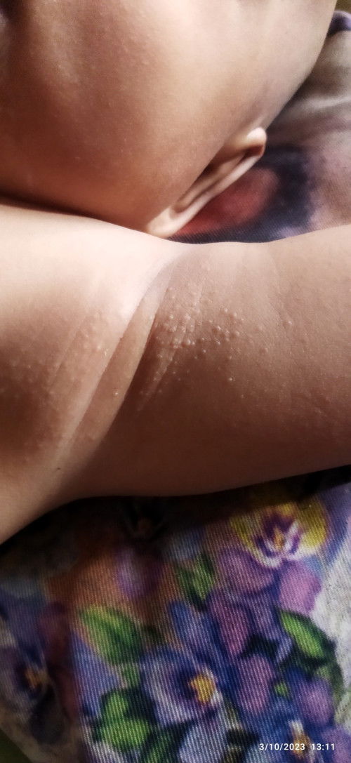 Bintik2 diketiak bayi