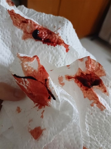 Bleeding Non Stop