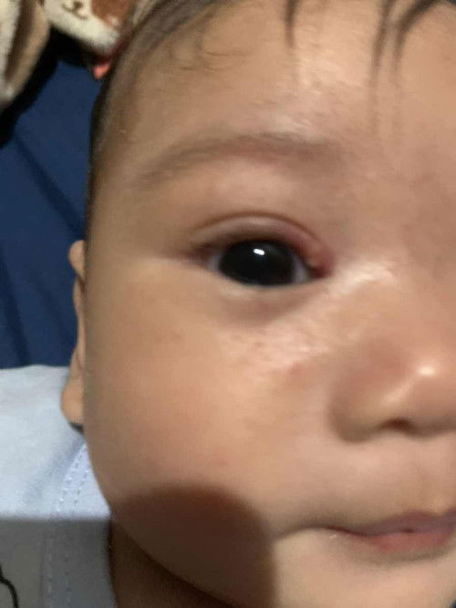 ตาลูกเป็นอะไรใครทราบช่วยบอกหน่อยค่ะ