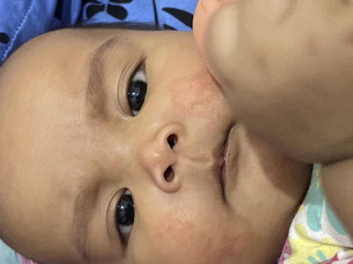 Ruam pada pipi bayi