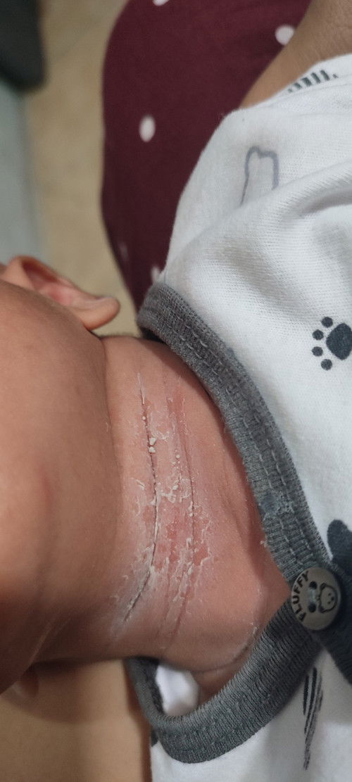 Kulit leher bayi mengelupas