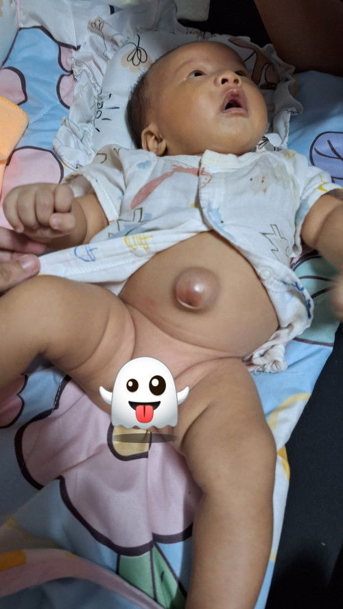 สะดือเด็กแรกเกิด