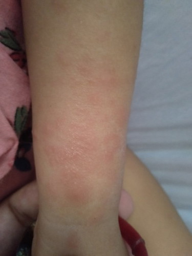 Rashes or allergy