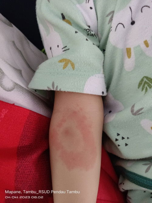 Merah di tangan awalnya cuma kecil