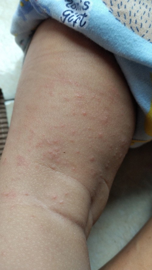 badan anak bentol merah2