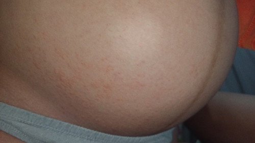 Pregnancy Rashes