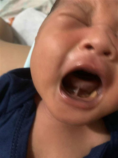 Tongue Tie