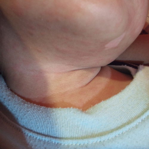 Muka sama badan merah merah setelah panasnya turun