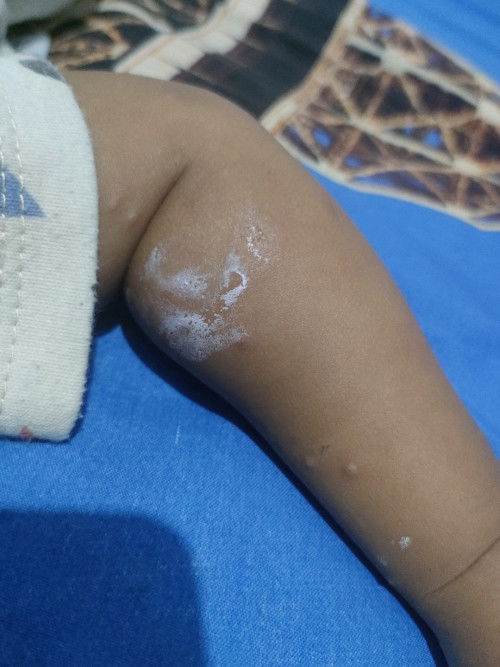 Anak gatel gatel apa salep yang cocok ya Bun?