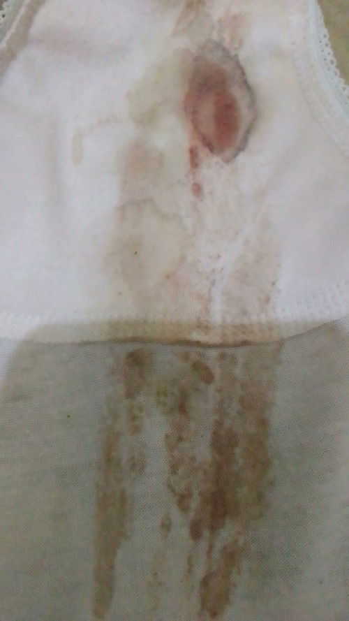 Sering keluar darah saat hamil 36-37 Minggu.