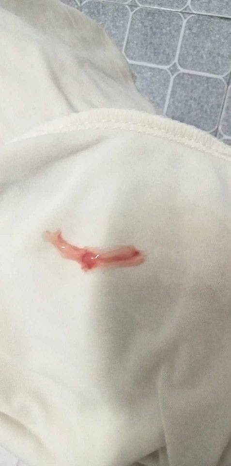 แบบนี้ต้องไปโรงพยาบาลไหมคะ