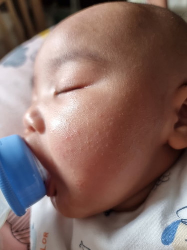 ตุ่มเม็ดบนใบหน้า