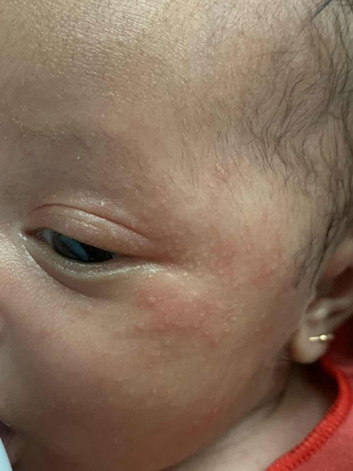 Biang keringat newborn