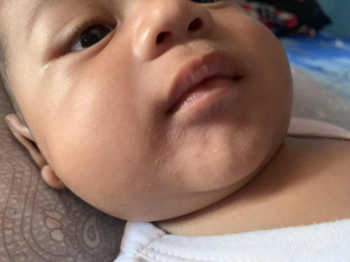 Ini bayi 4 Bln tb” bintik merah di bawah bibir , mikirnya karna kena sufornya , gimana ya bun ?