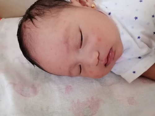 Red spot sa newborn