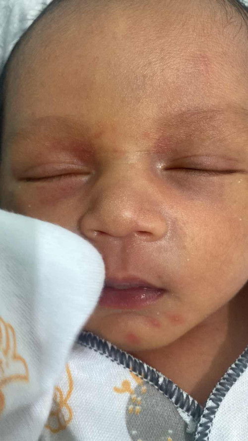 Merah pada muka bayi