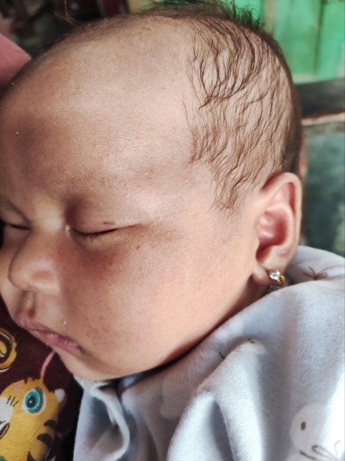Bayi bruntusan (?)