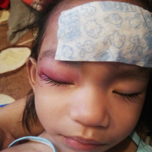 Kagat po ba toh ng ipis pleaseee need help ASAP