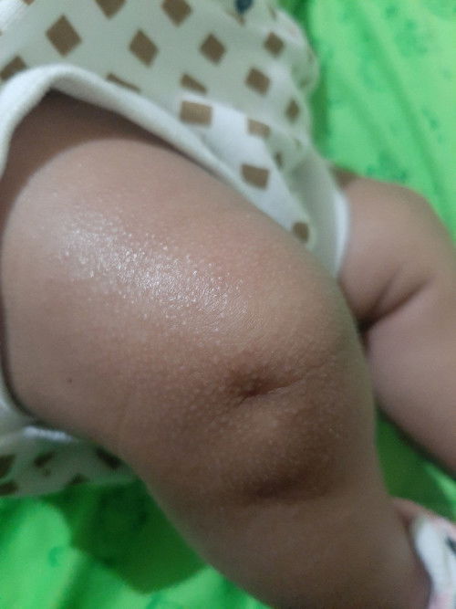 Kulit bayi bertekstur seperti chicken skin